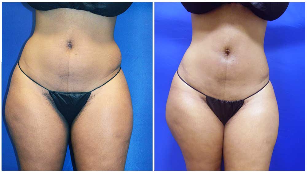 Can You Be Too Skinny For A BBL? - Atlanta Liposuction Specialty