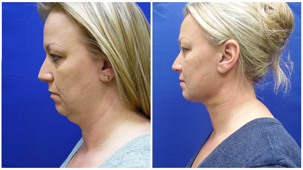 Sculpt the Chin & Neck With Liposuction