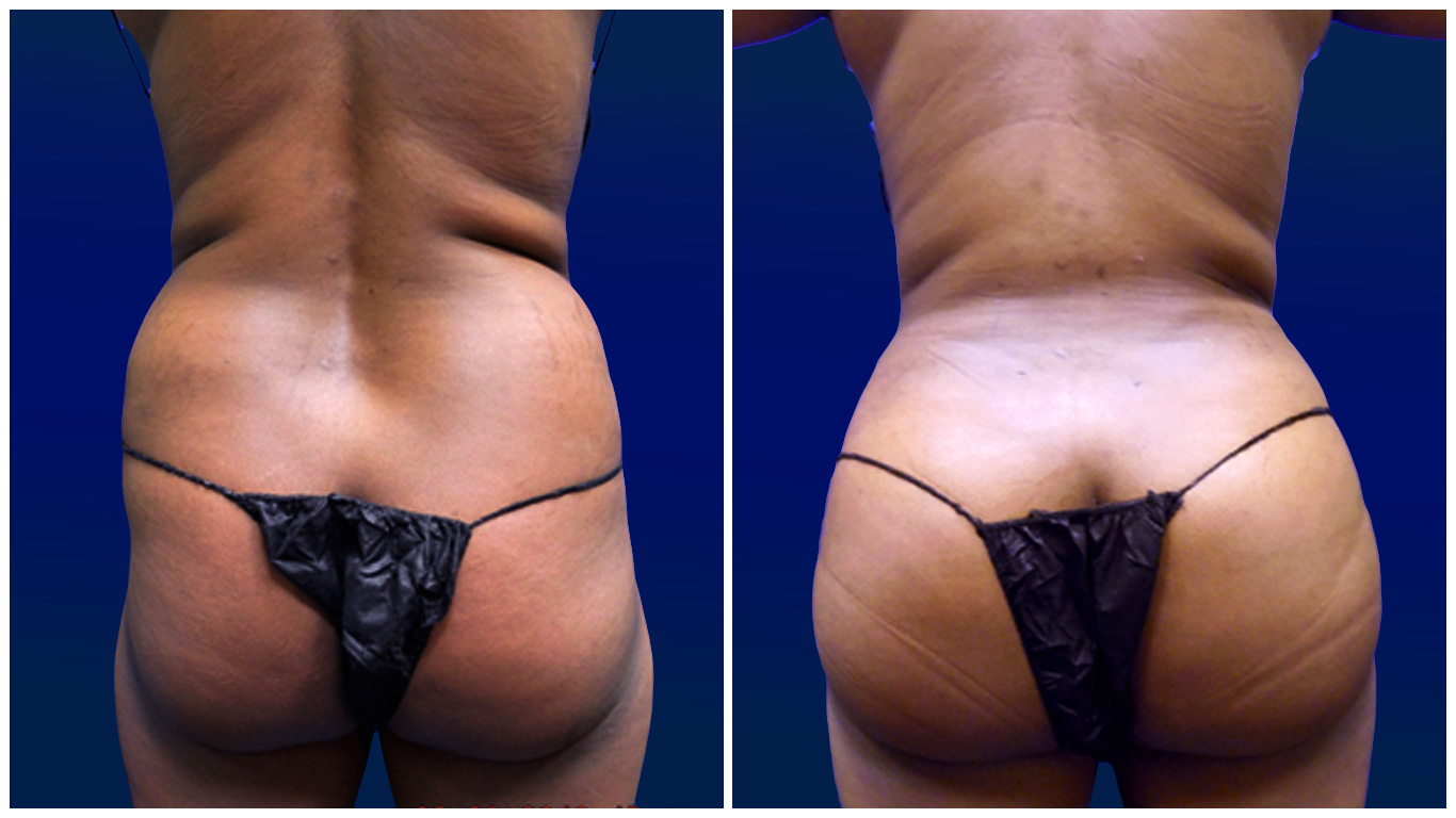 Brazilian Bum Lift - BBL Surgery